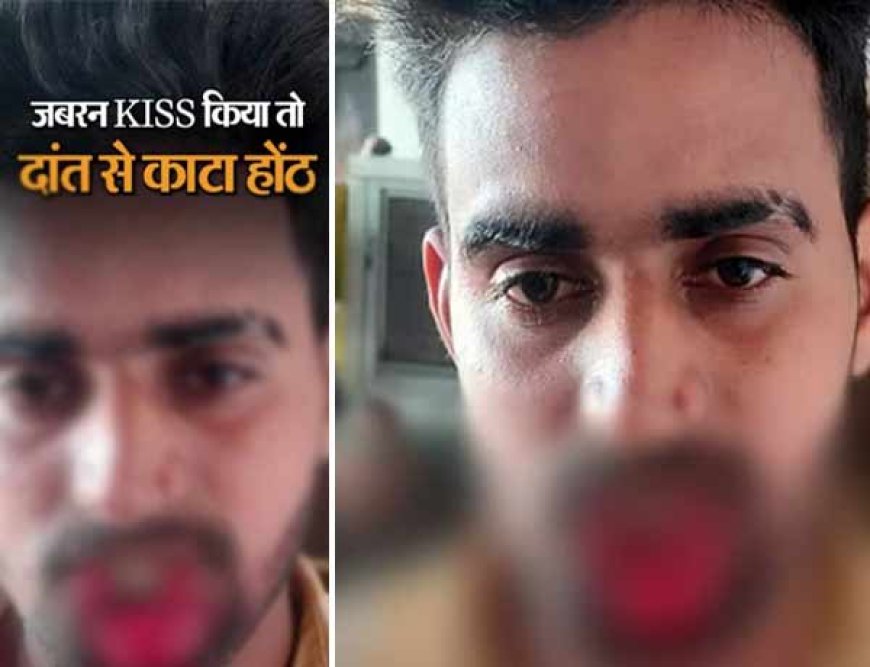 जबरदस्ती Kiss करना पड़ा युवक को भारी, लड़की ने दांतों से काटकर अलग कर दिया होंठ